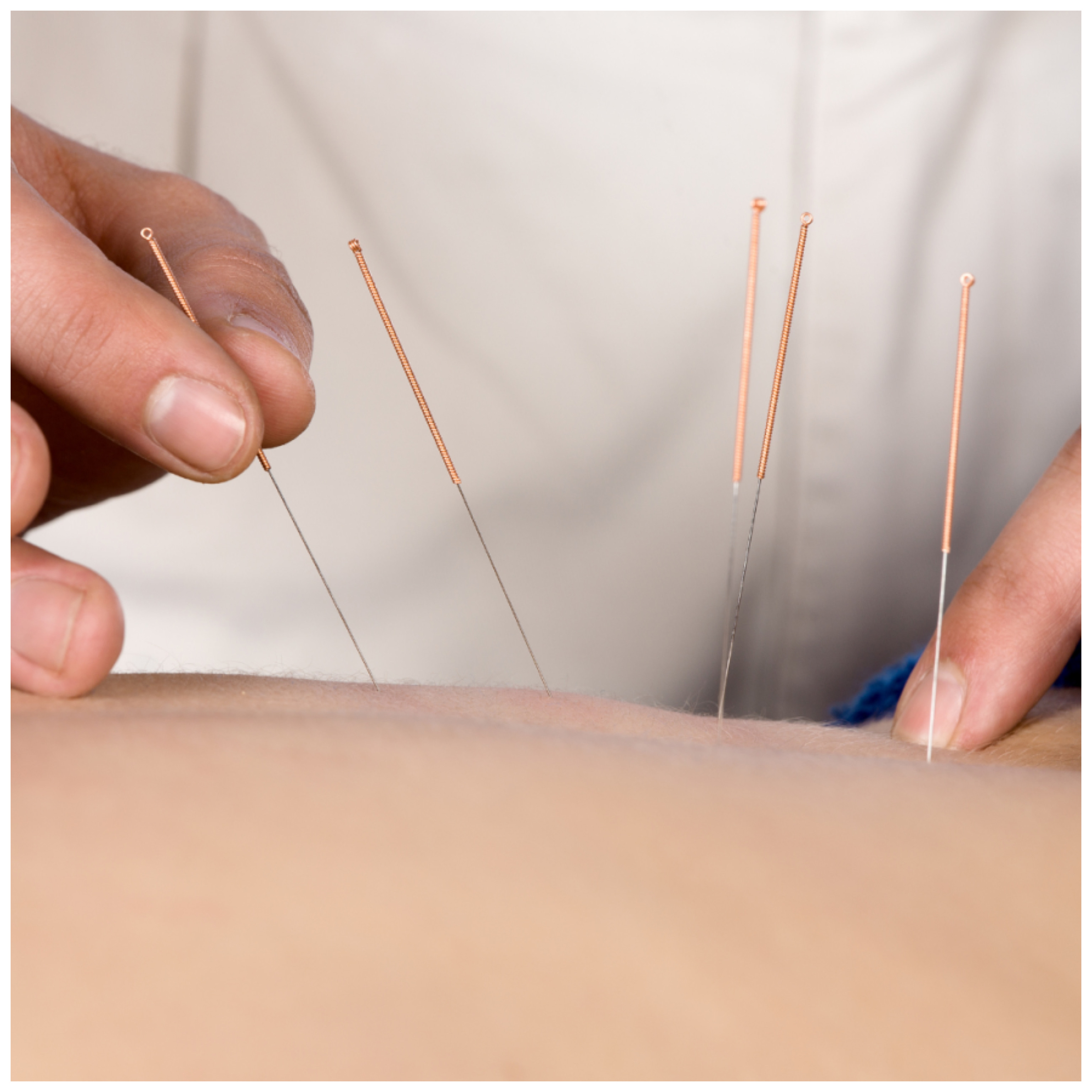 acupunture